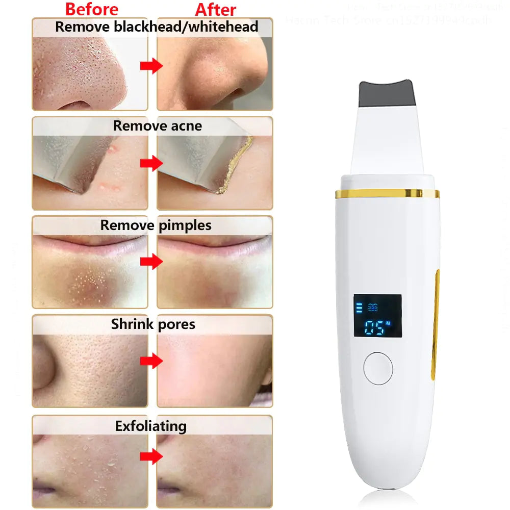 Ultrasonic Skin Scrubber: Facial Cleansing WEM Support (www.WEM.support)