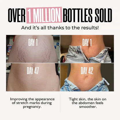 Stretch Mark Removal Cream WEM Support (www.WEM.support)