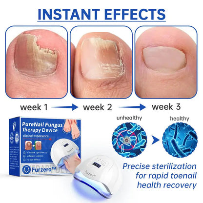 Fungus Laser Therapy Device WEM Support (www.WEM.support)