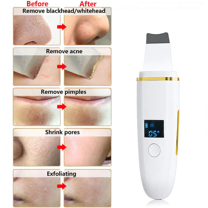 Ultrasonic Skin Scrubber: Facial Cleansing WEM Support (www.WEM.support)